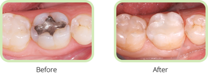 Before and After image of Mercury Toxicity in Dentistry Fort Lauderdale FL Area